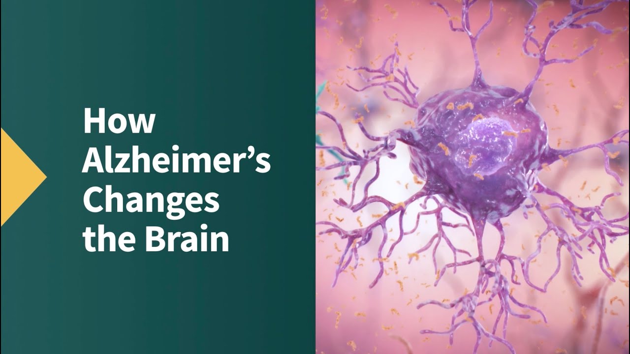 How Alzheimer's Changes the Brain