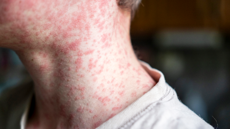 Measles Is Back and Two Researchers Say It Reveals Something Bigger