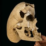 The Medieval Knight Who Lived With a Rare Genetic Disorder and Died in Battle