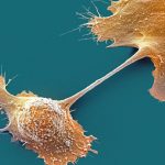 Experimental Drug Just Doubled One-Year Survival in Pancreatic Cancer