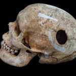 The Medieval Giant in a Mass Grave Had Already Survived Brain Surgery
