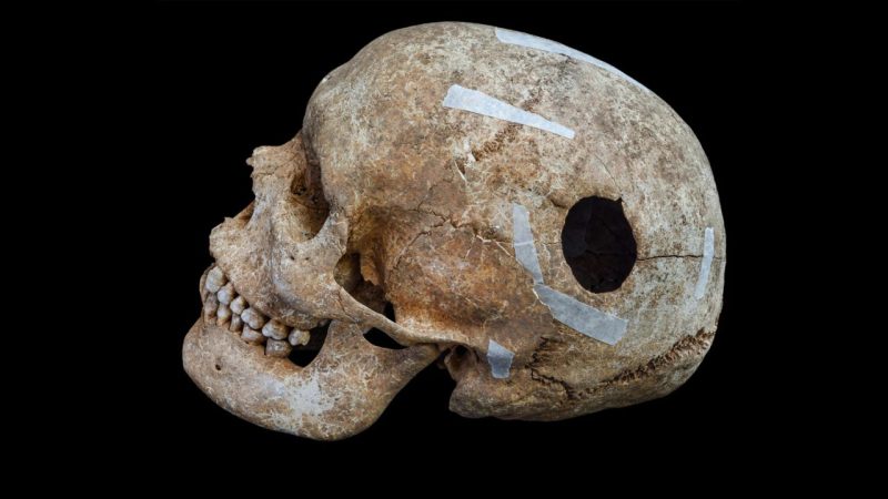 The Medieval Giant in a Mass Grave Had Already Survived Brain Surgery
